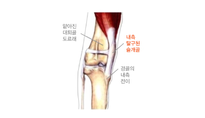 탈구된 슬개골